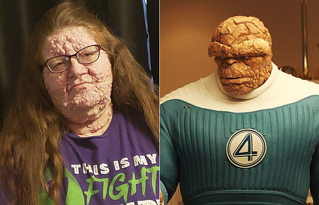 Žena vypadá jako postava ze sci-fi filmu. Příčinou je vzácné onemocnění