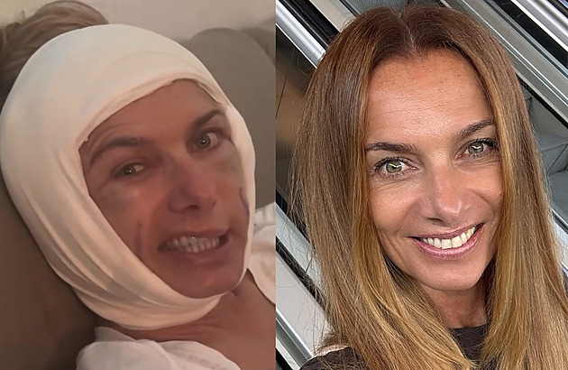 Oteklý obličej, nehybná půlka tváře a podlitiny. Alice Bendová vyděsila fanoušky